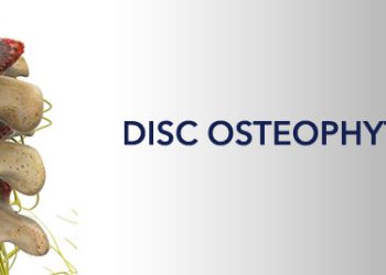 What-is-the-Posterior-Disc-Osteophyte-Complex