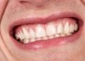 metlife dental