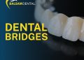 Dental Bridges Toronto