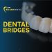 Dental Bridges Toronto