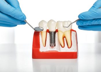 Do Dental Implants Resemble Your Natural Teeth?