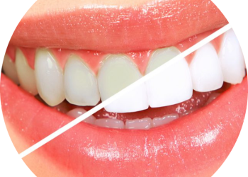 Teeth whitening Surrey