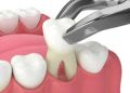root canal specialist near me