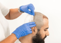 What To Know Before Choosing Hair Transplant Clinic in India