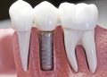 dental implant solutions