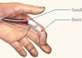 Trigger finger treatment Singapore