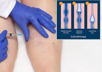 Varicose Vein Treatment in Singapore: A Comprehensive Guide